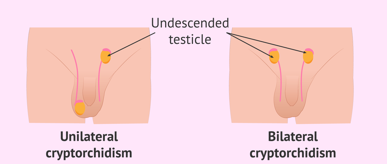 bilateral-unilateral-cryptorchidism